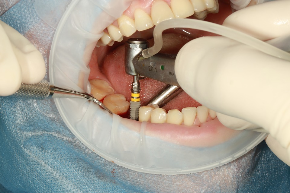 6 Reasons to Get Dental Implants