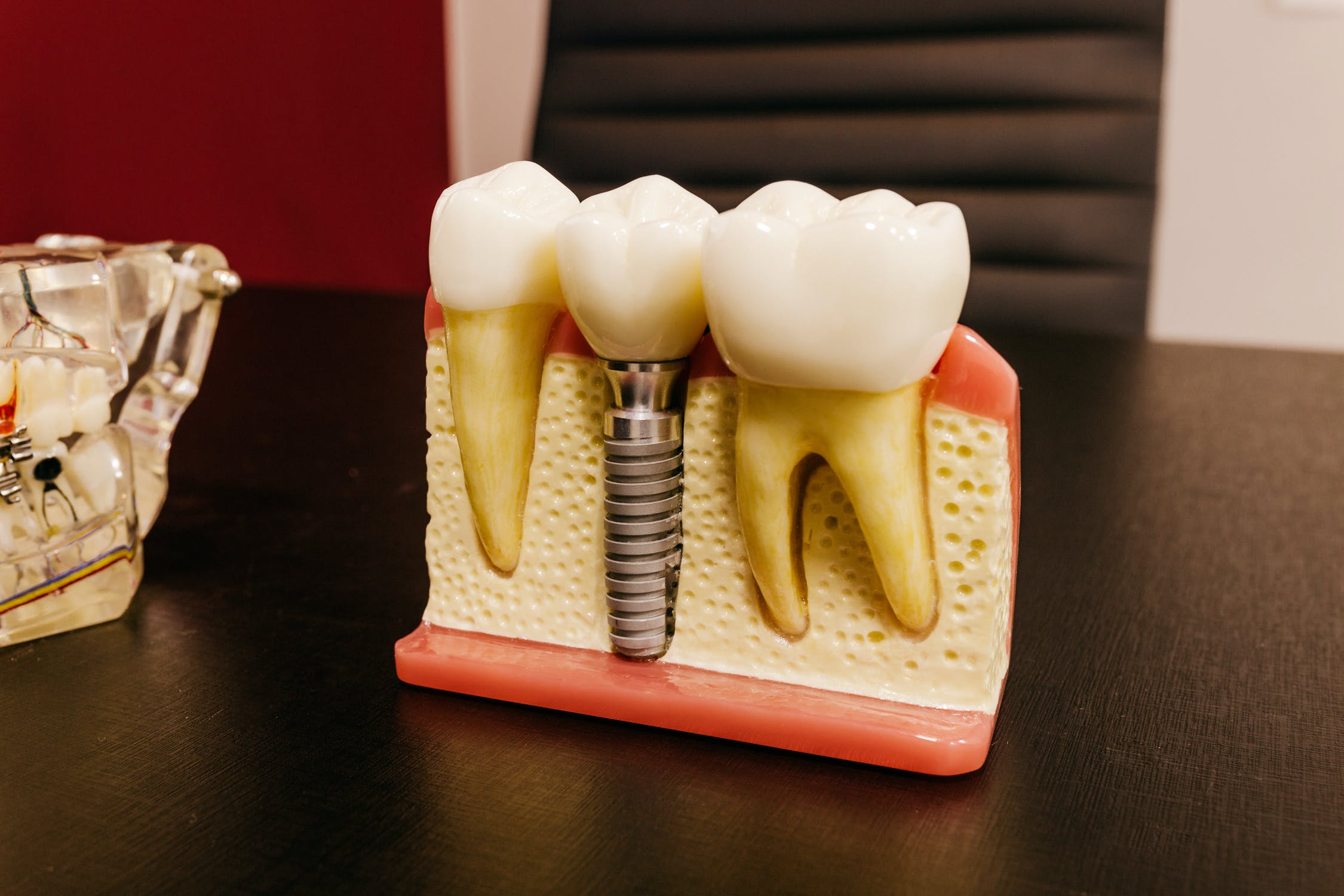 How Long Does It Take to Get a Dental Implant