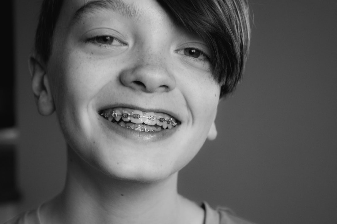 4 Things Parents Should Know Before Getting Braces for Their Kids