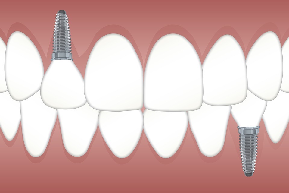 How Long Does a Tooth Implant Last
